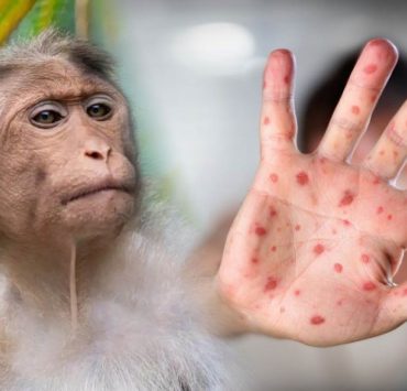 Veracruz registra primer caso de viruela del mono; hay 49 confirmados en México