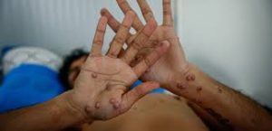 Cuatro estados de la República Mexicana, han reportado casos de Viruela del Mono.